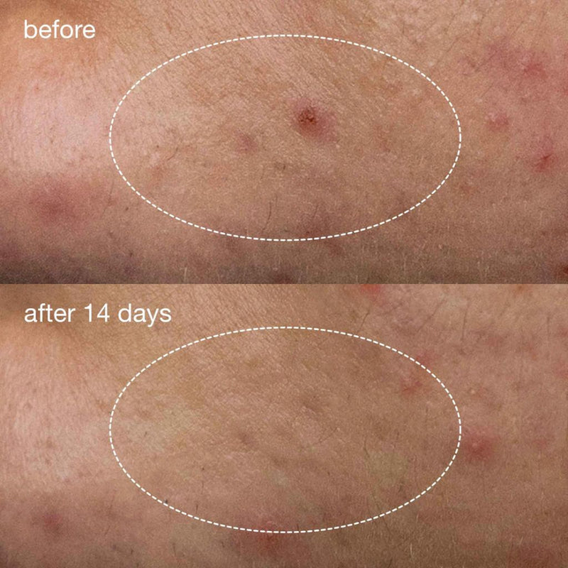 Dermalogica Deep Acne Liquid Patch