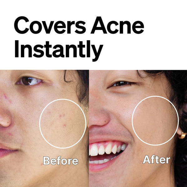 FRONTMAN Fade Skintone Acne Treatment